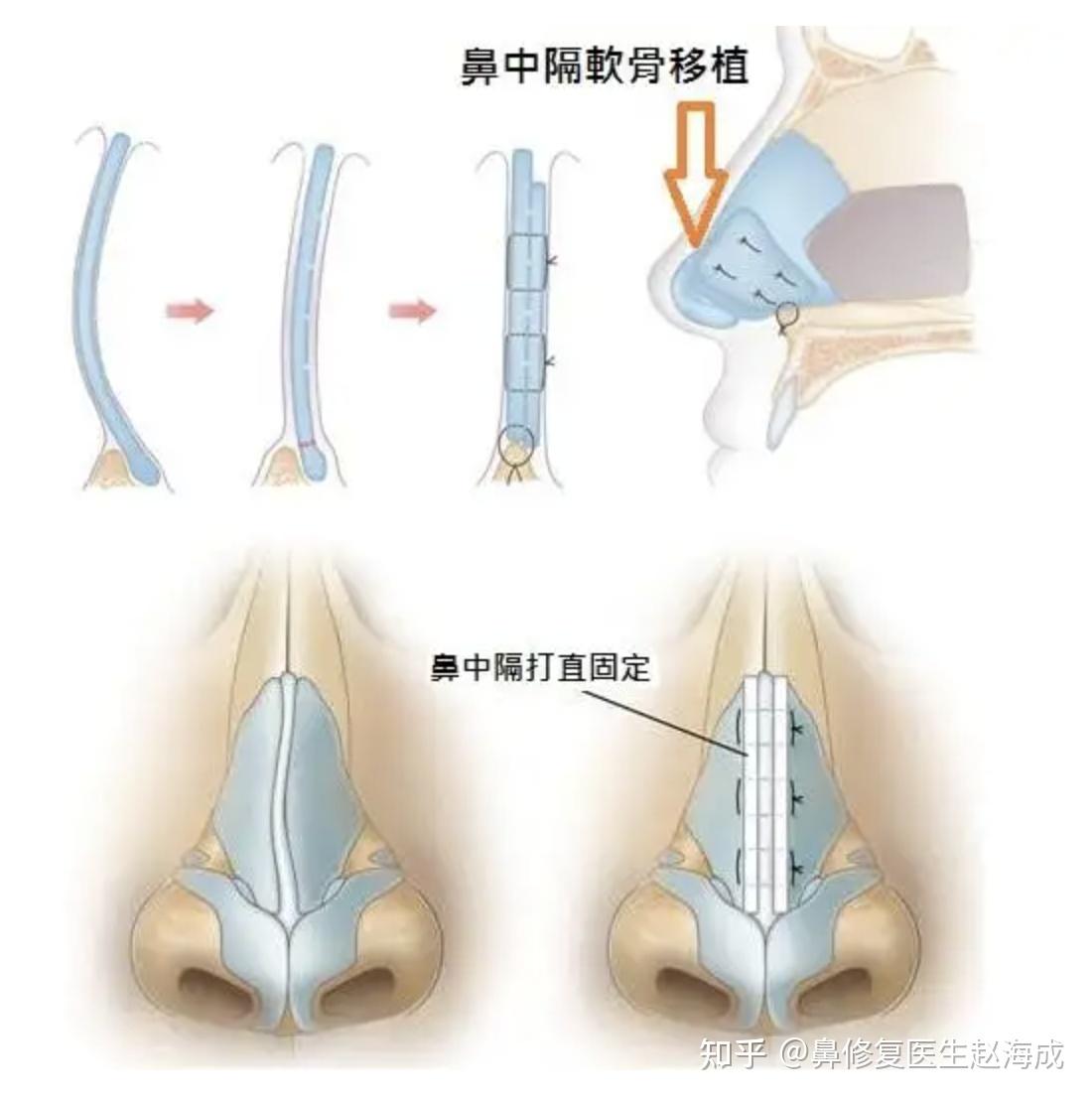 鼻骨矯正術需要開刀嗎有危險嗎