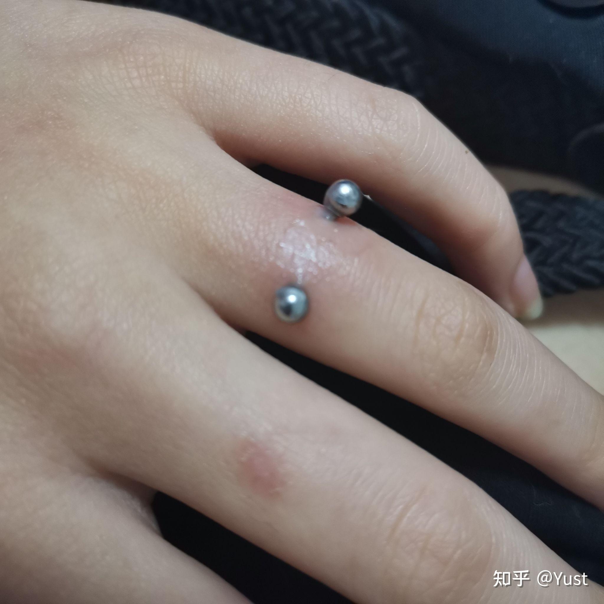 手指钉orward helix恢复记录