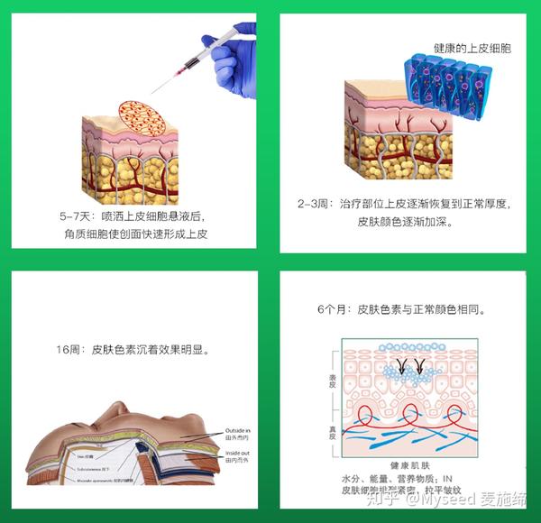 自体活性皮肤细胞移植再生术治疗大面积白癜风的专项技术