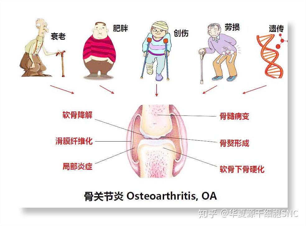 和损害,上下骨相互直接摩擦,导致关节退变,骨质增生的慢性骨关节疾病