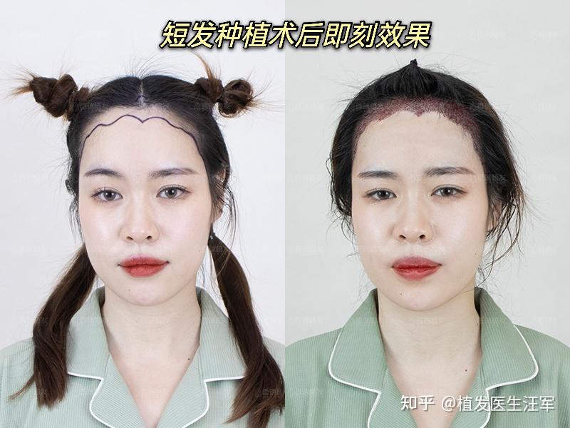 女生做植发(女生植发有什么危害)