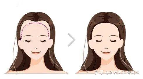 女性发际线调整:如何设计自然感发际线? - 知乎
