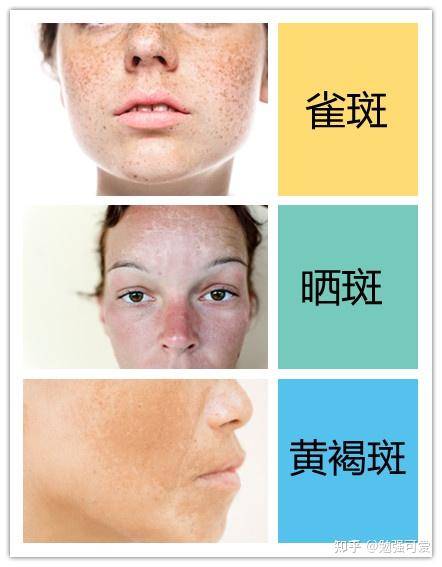 黄褐斑表现:面部两颊的黄褐色斑点,包括蝴蝶斑,肝斑,肾斑等,斑点