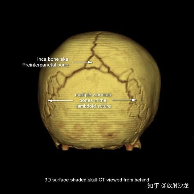 颅骨盲孔图片