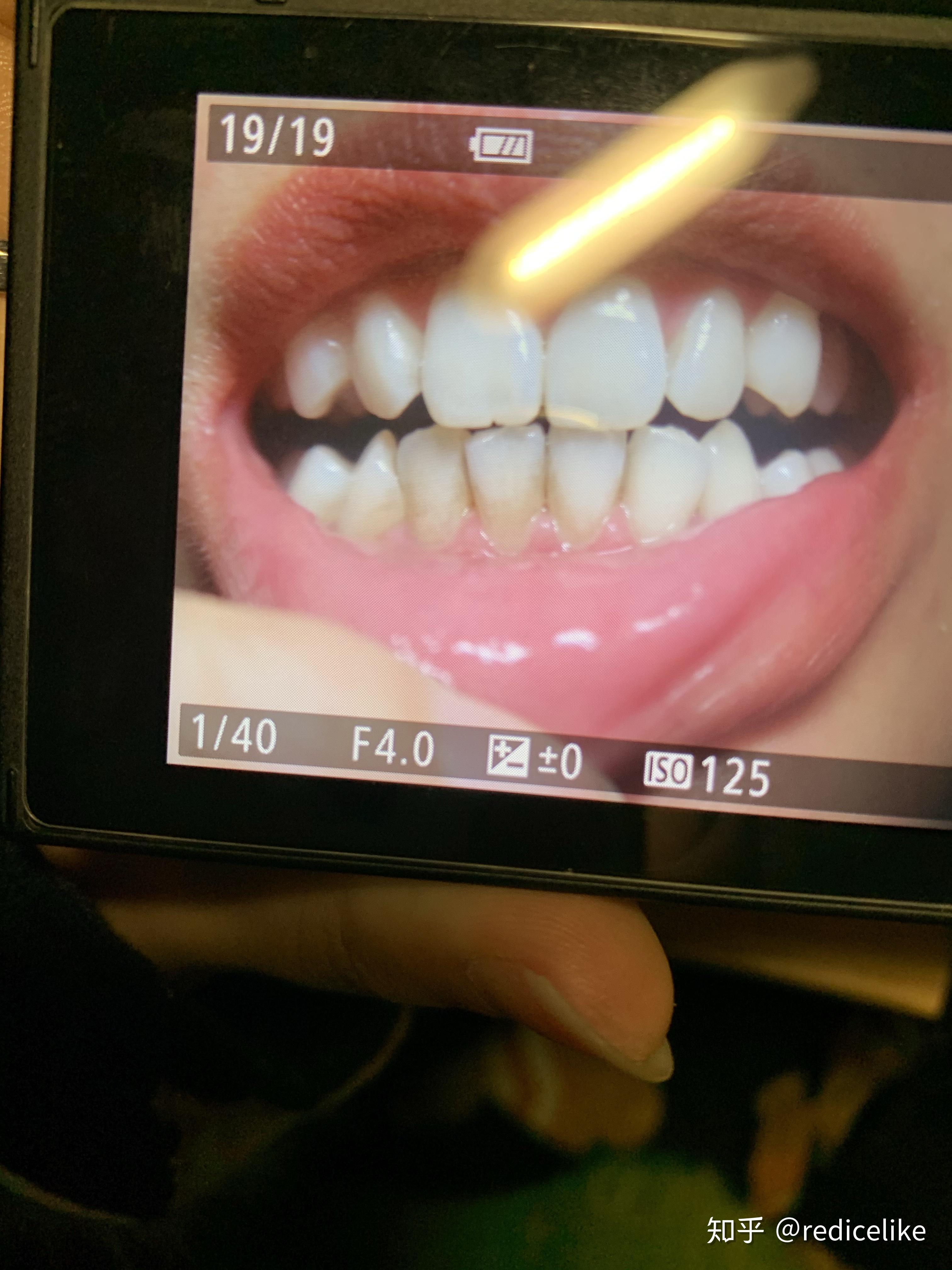 牙齿突然表面变黑