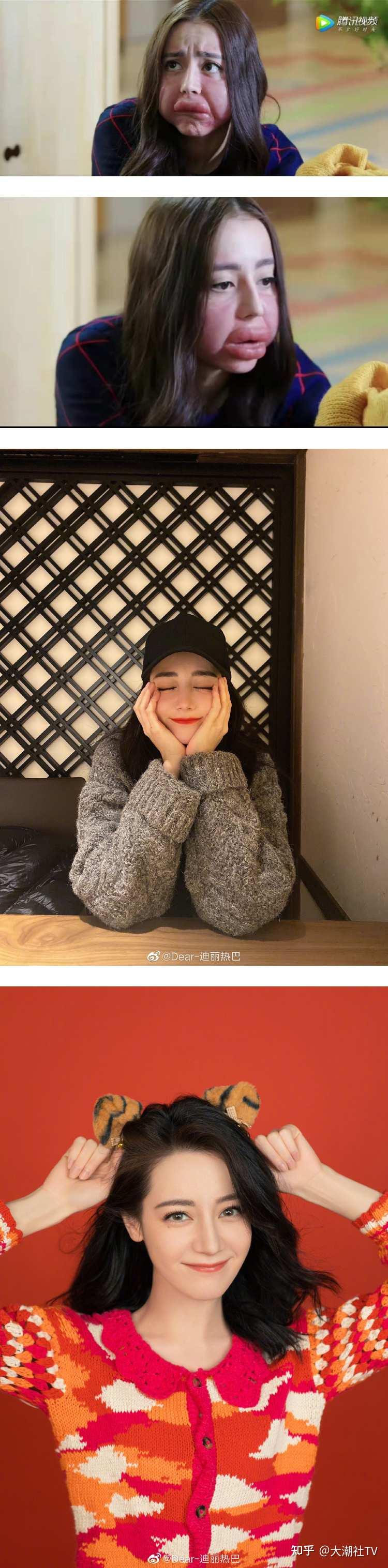迪丽热巴肿成猪头香肠嘴网民看傻眼绝世美颜崩坏了