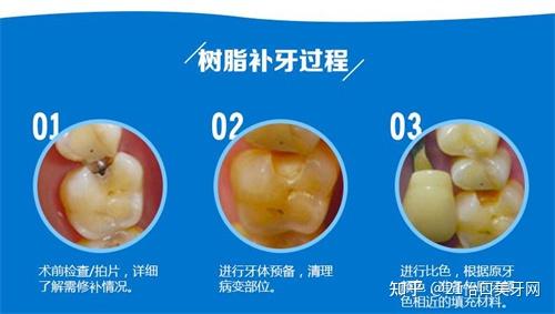 口腔医院补牙多少钱一颗?三甲医院补牙价格表上线,国产进口树脂/嵌体补牙价格超详细 - 知乎