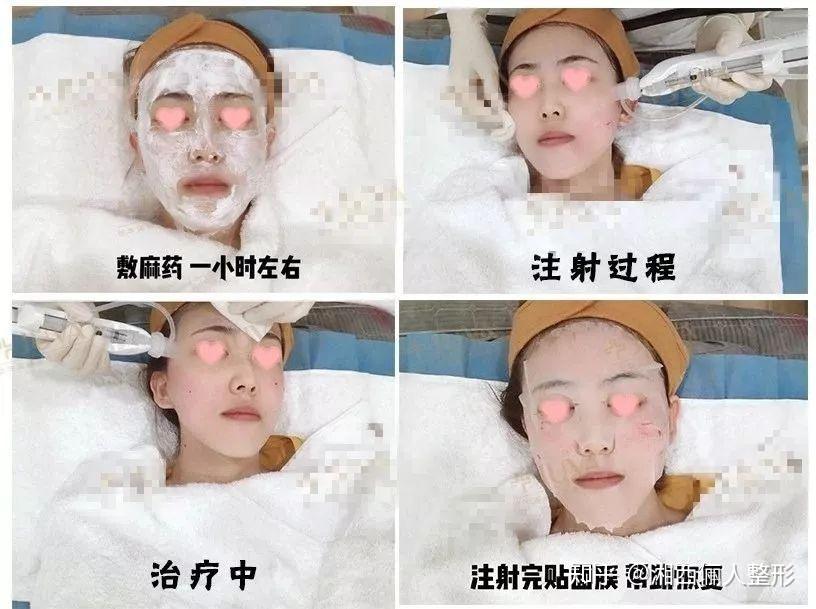 明星都在打的水光针为什么效果比你好