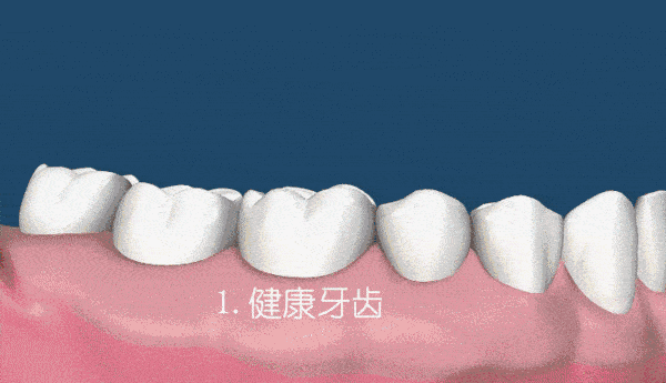 牙龈萎缩不可逆