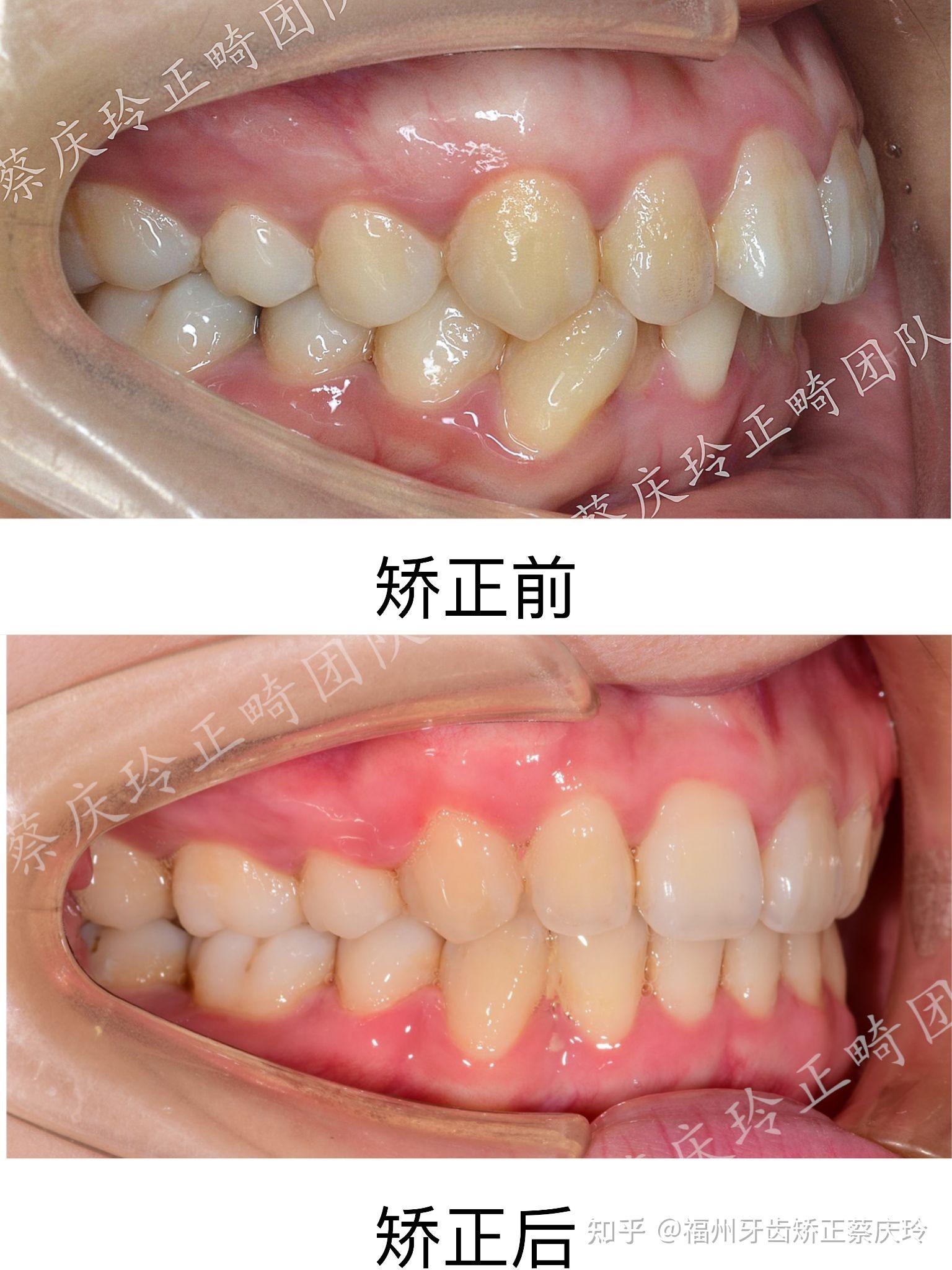 蔡庆玲正畸团队缺牙深覆合案例