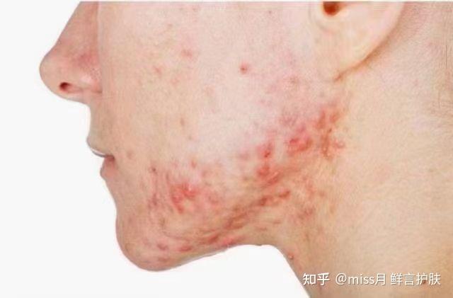 早间科普:腮边痘 - 知乎