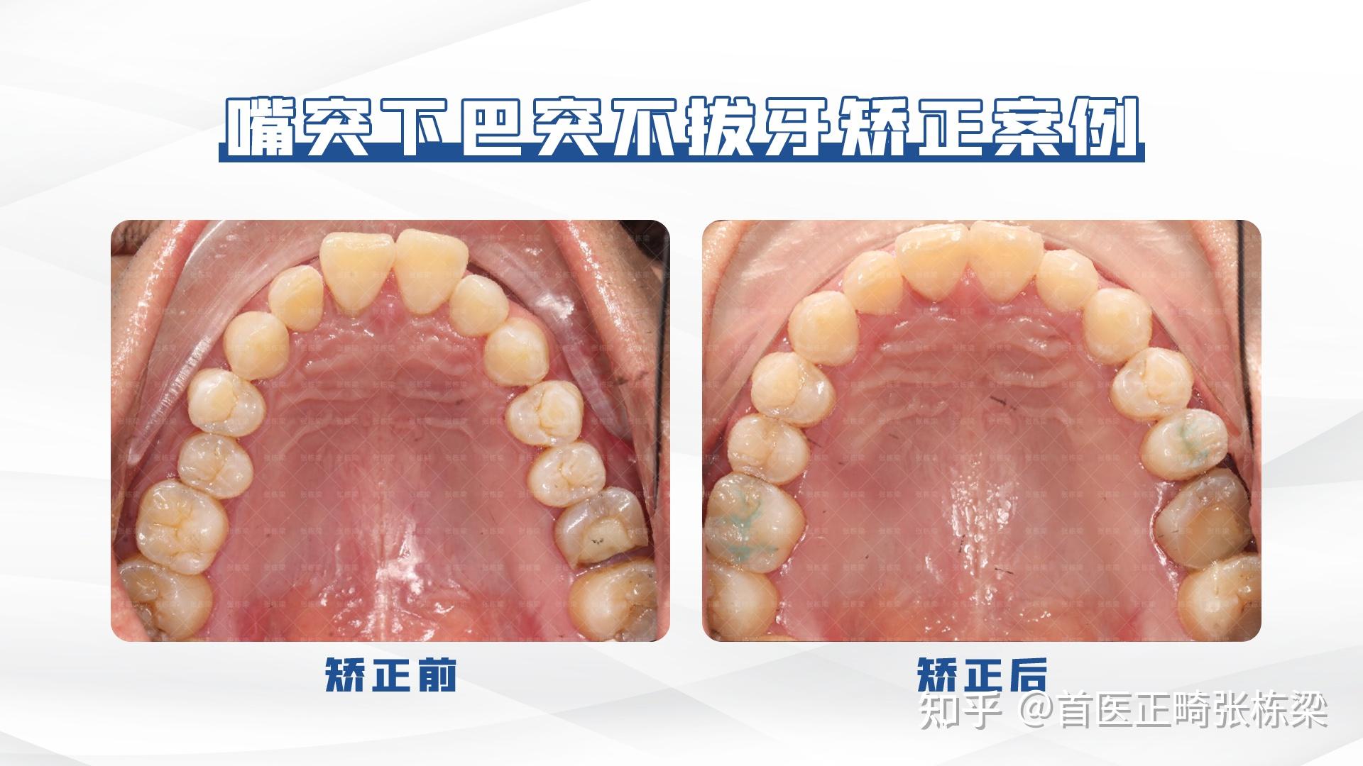 的男生一直被嘴突,下巴突影響自信心,矯正前男生的上下前牙非常唇傾