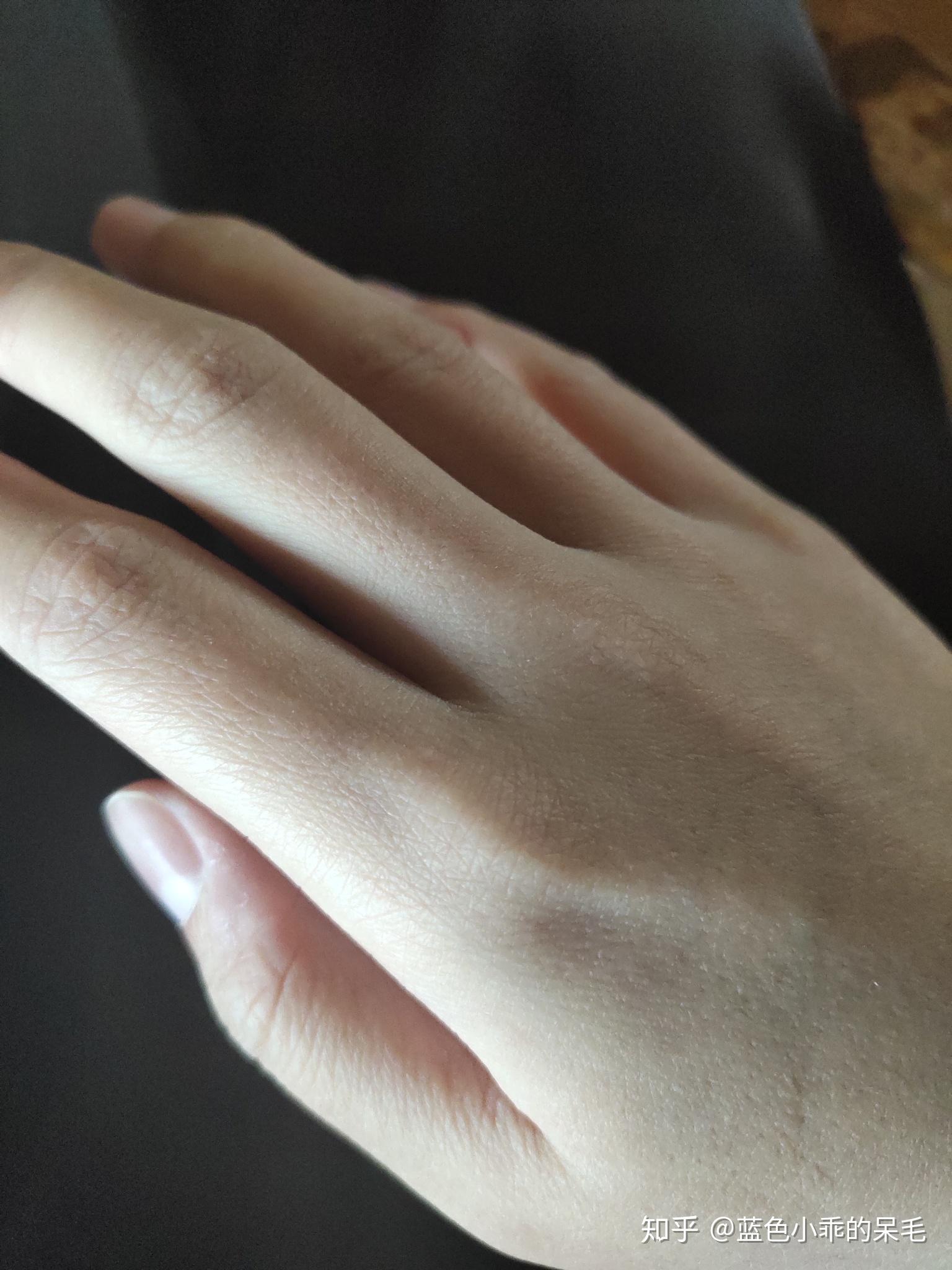 请问鱼鳞病患者的手都是老人手吗?