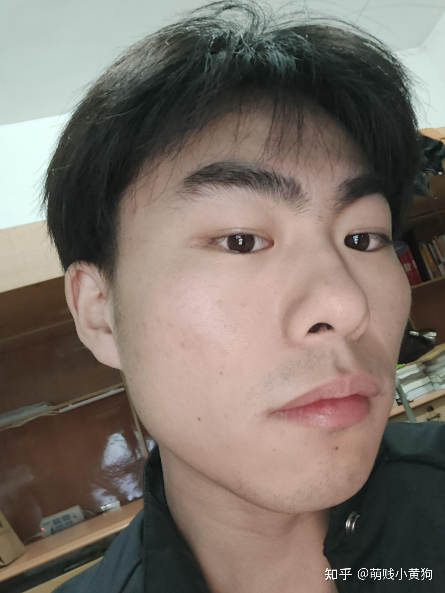 光子嫩肤去痘印记录