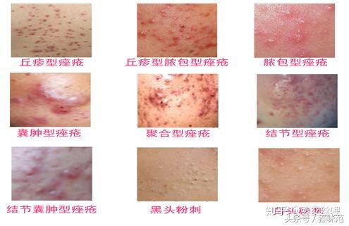 痤疮皮肤之祛痘 知乎