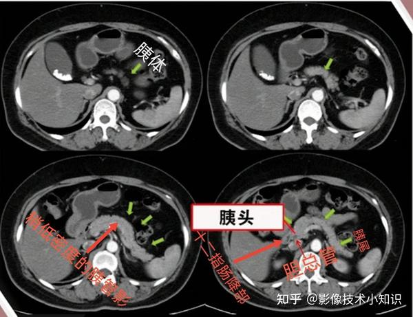 胰腺影像解剖 - 知乎