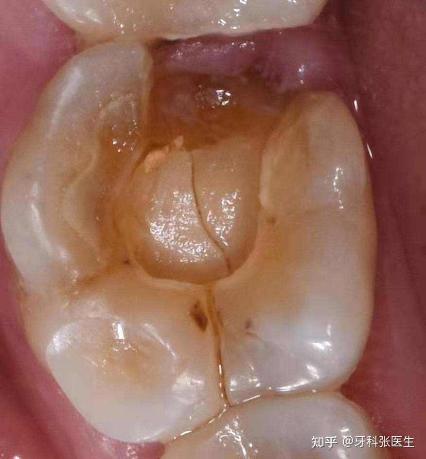 牙齿中间可见一条明显劈裂线而当做了牙套后,牙套为一个整体,同时将