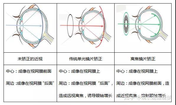 戴ok镜太麻烦,孩子近视度数增加又太快该怎么办?