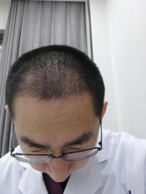 医生脱发了会不会去植发来看植发两年的效果记录