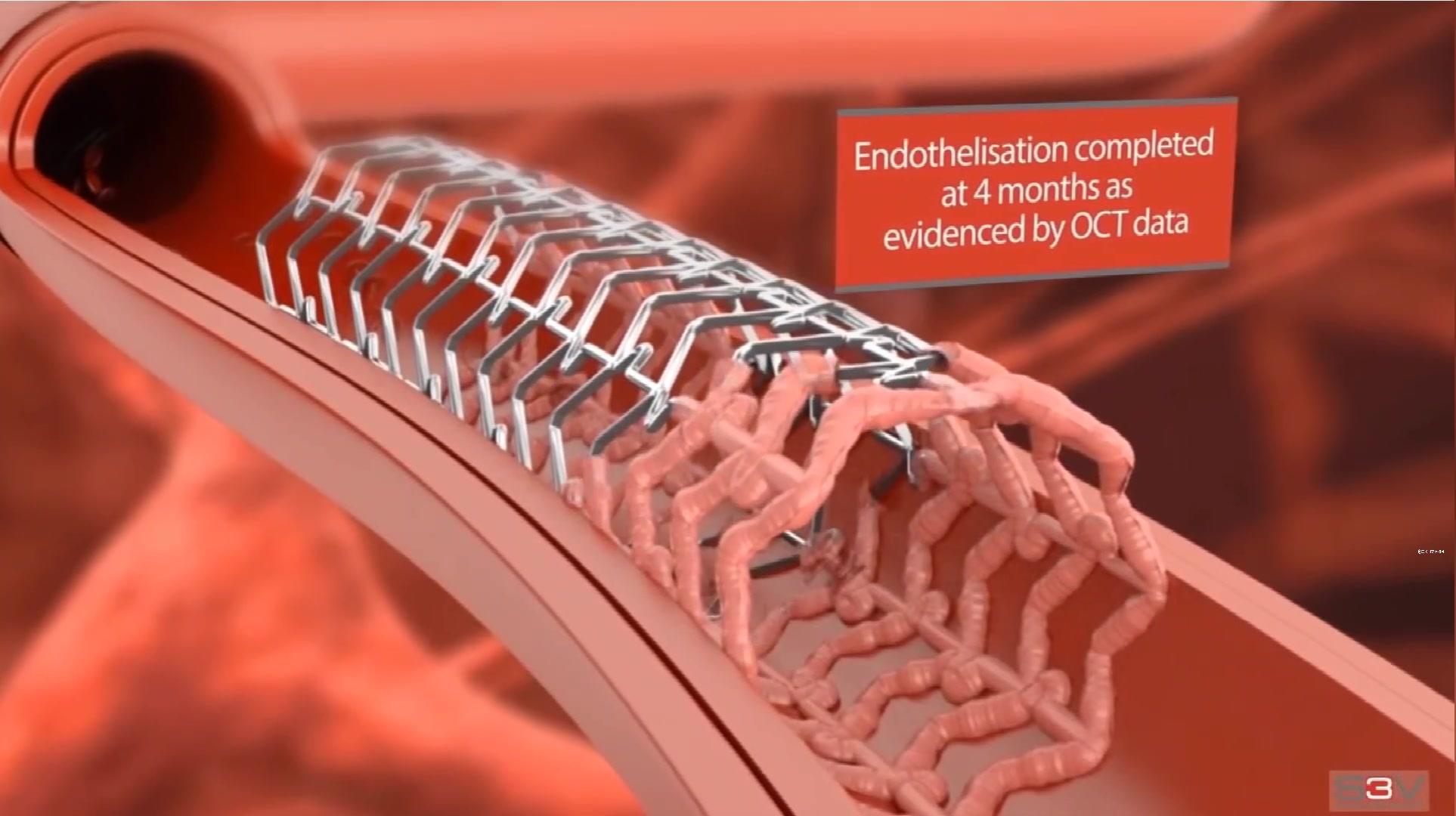 3:38动画带你走入神奇的心脏介入手术,了解血管支架的工作原理哈尔滨