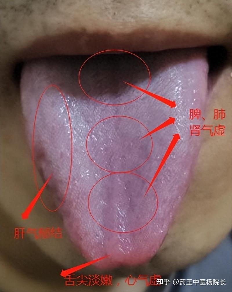 舌象分析：从脱发舌象，找脱发的“根”！ - 知乎