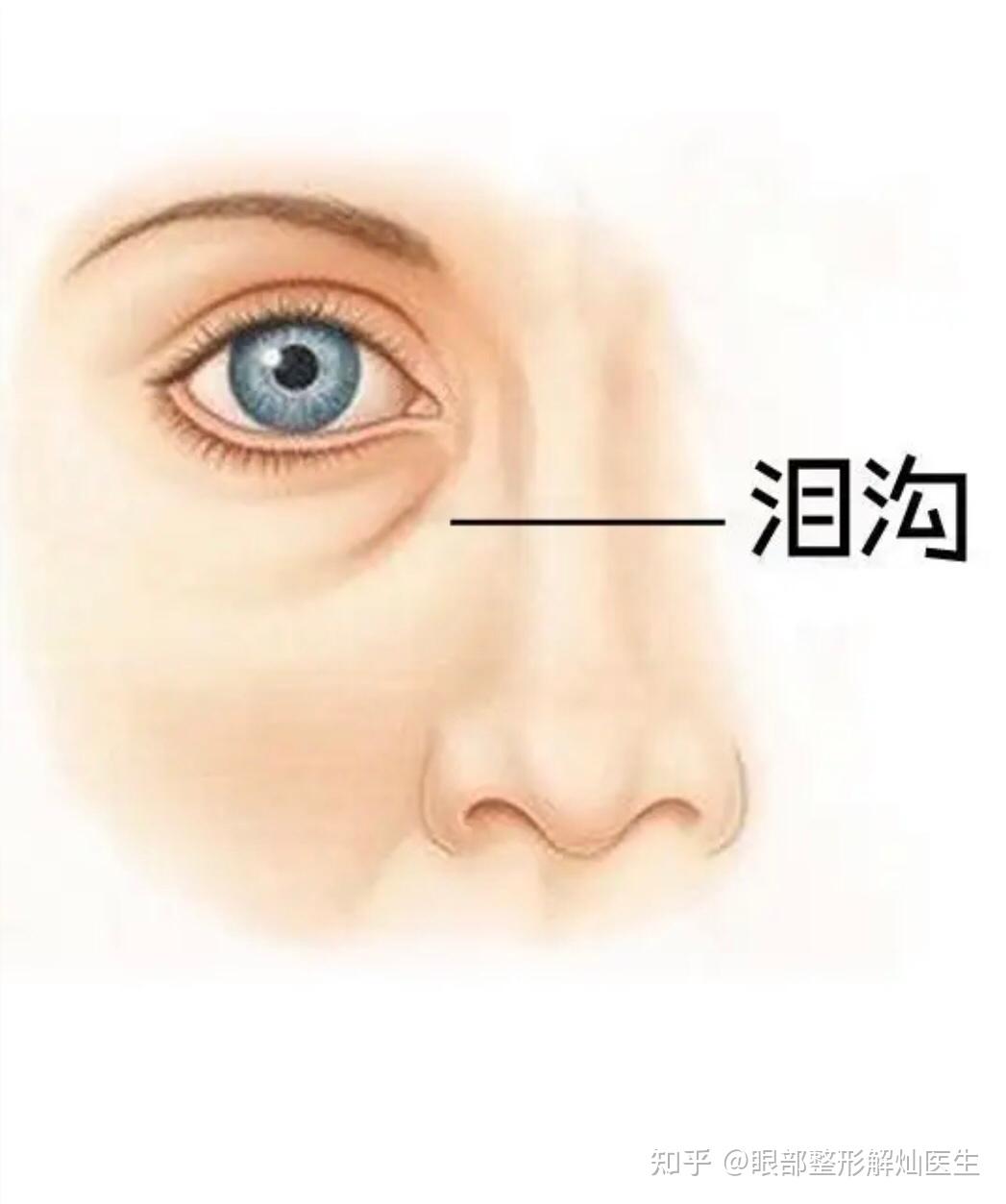 泪沟是怎样形成的？ - 知乎