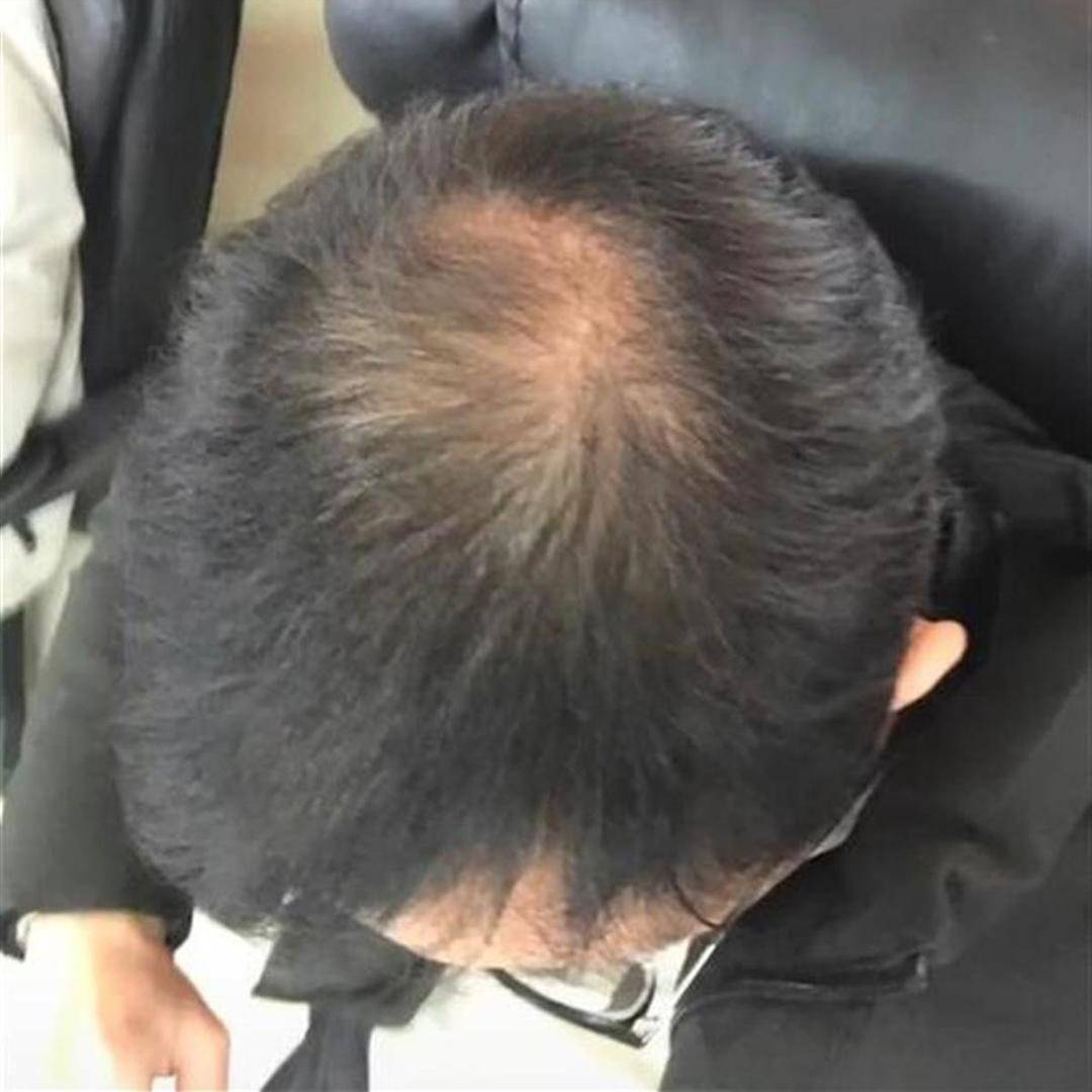 男子秃顶半月不用洗发水后长出头发网友洗发水公司要破产了