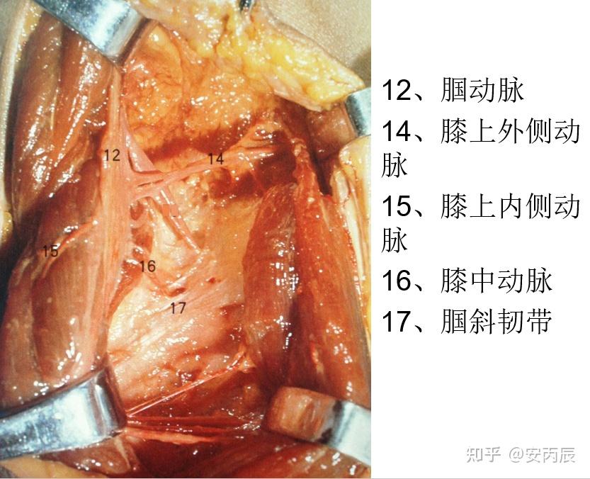 腘窝囊肿手术图谱图片