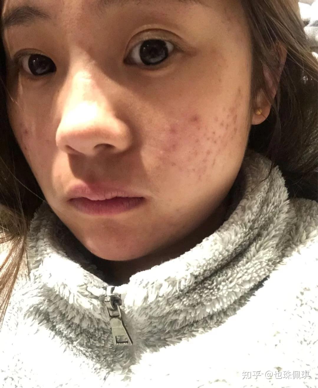 脸上痘痘很严重怎么办