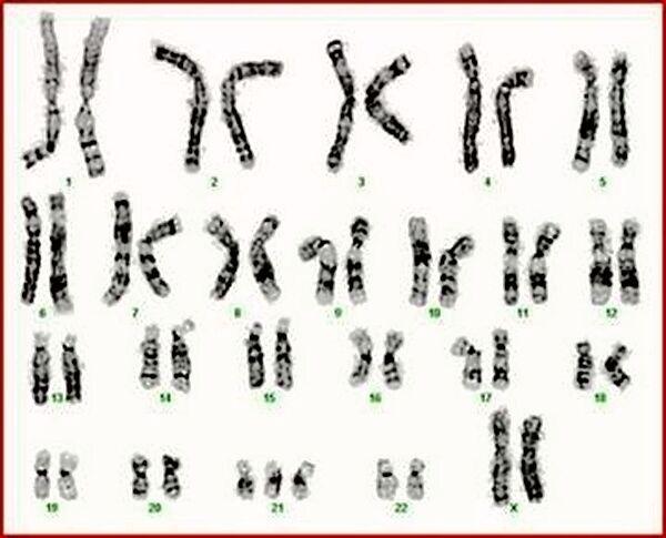 13三体综合征染色体图片