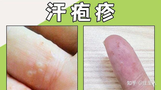 手上汗疱疹的怎么治疗? - 知乎