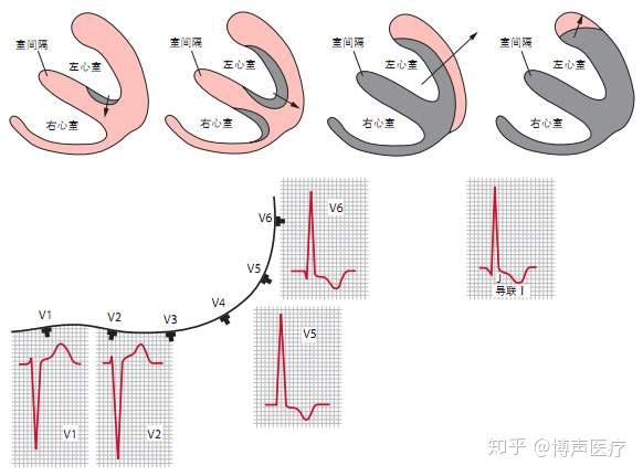 博声医疗 左室高电压 左室高电压心电图 知乎