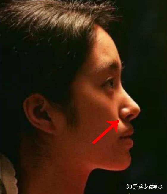 鼻基底填充的效果怎么样怎么判断鼻基底是否凹陷
