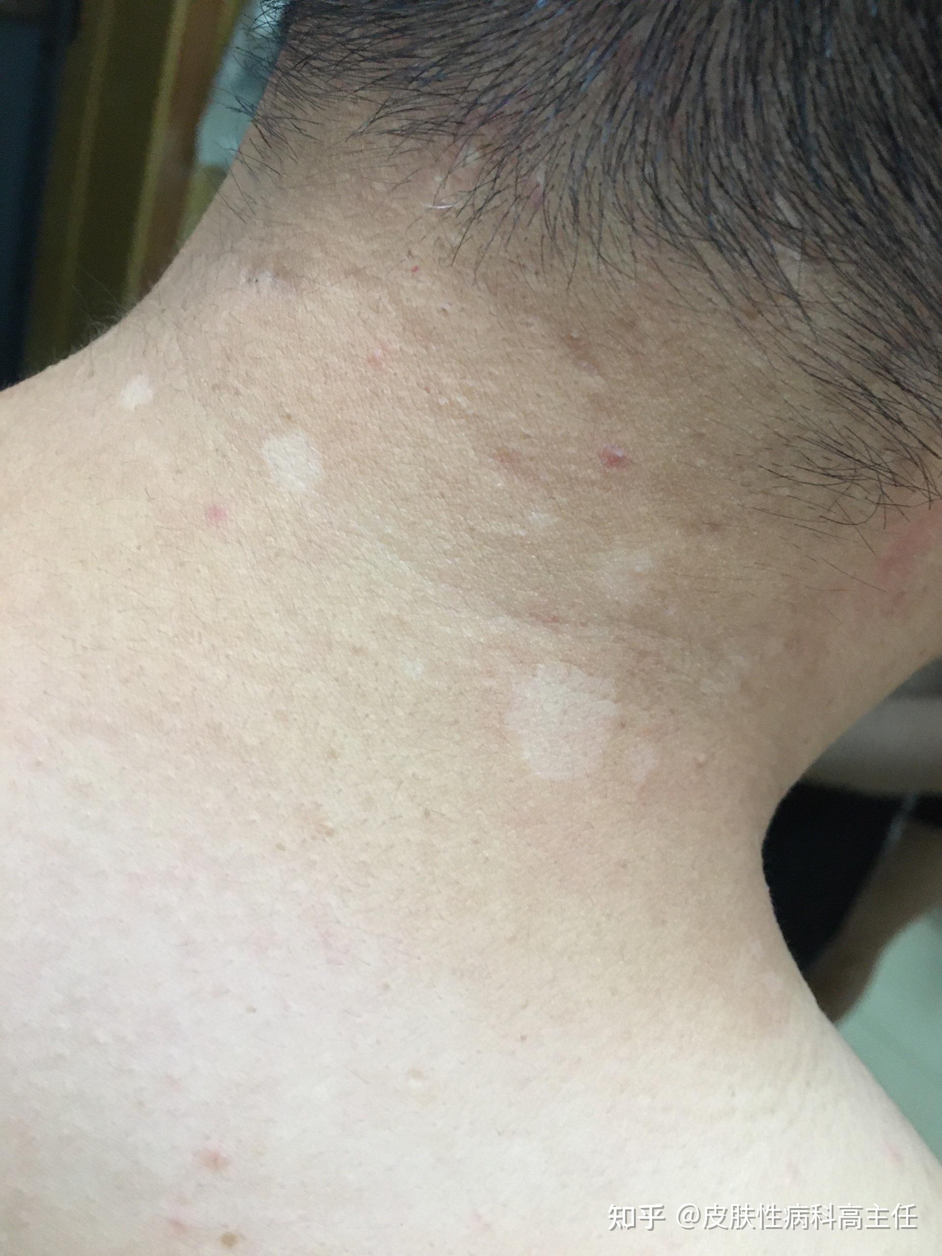 阳光暴晒皮肤也会有白斑吗?