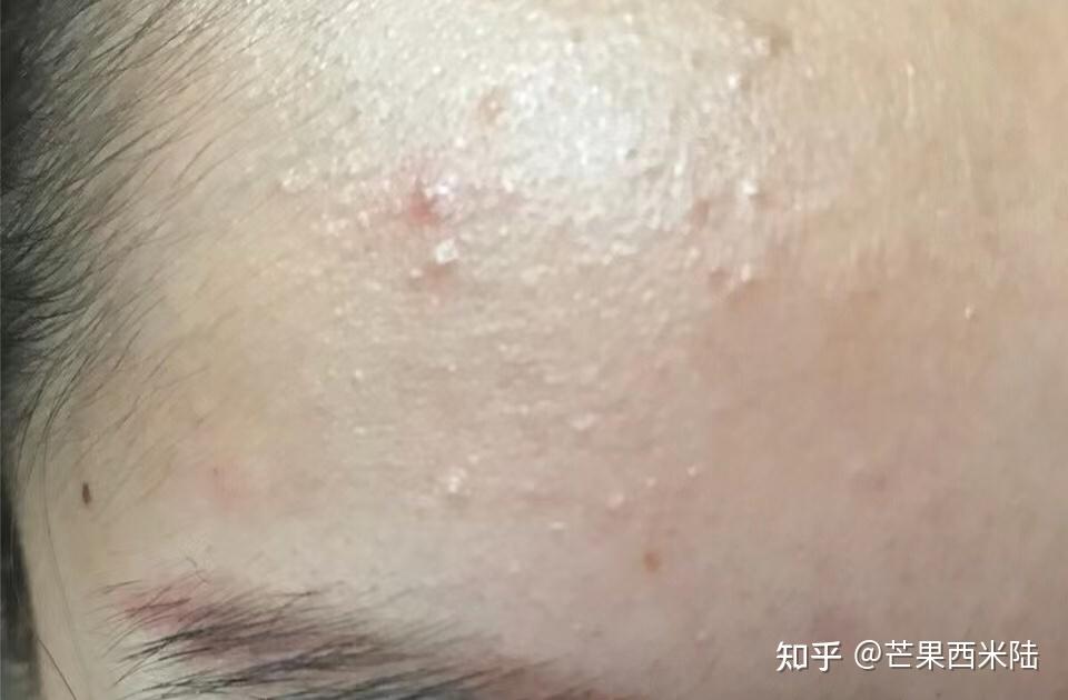作为一个干皮脸上却经常长闭口该怎么办?