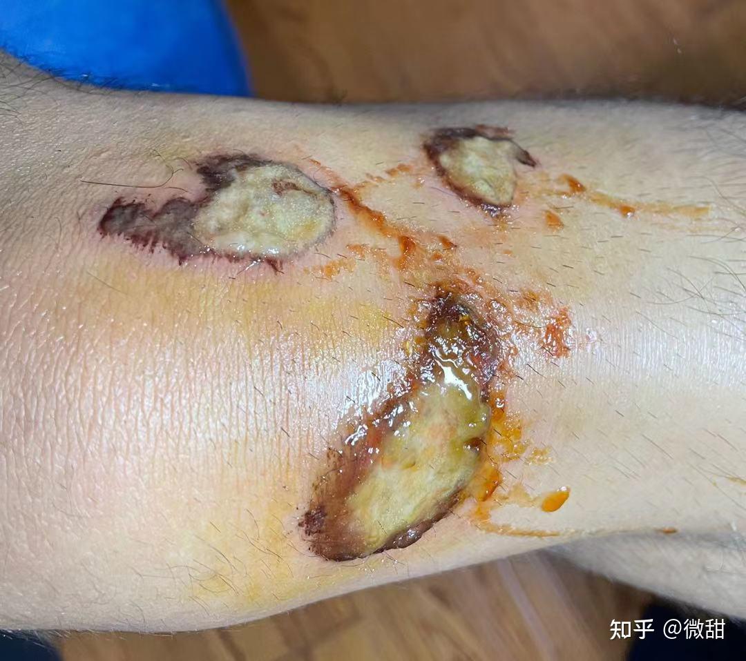 膝盖伤口化脓图片图片