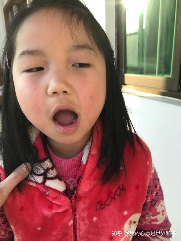 面瘫后遗症能治好吗