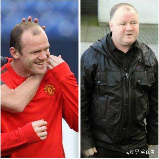 秃顶谢顶遗传规律雄性激素源性脱发遗传规律科普