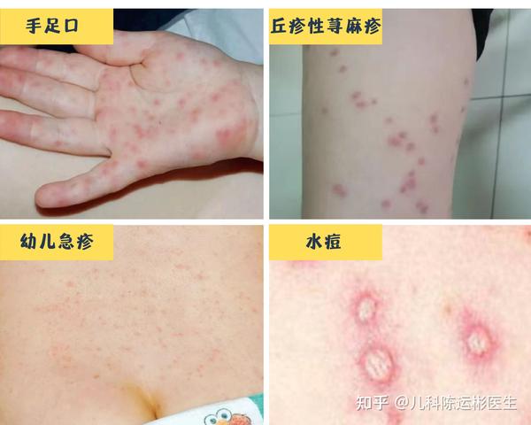 宝宝长红疹子就是手足口?3个方法教你鉴别 - 知乎