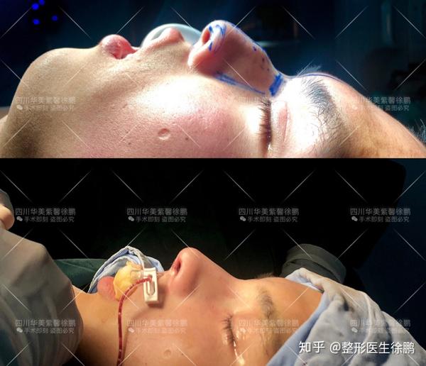 驼峰鼻整形手术一般在局麻下进行, 手术时间一般为两小时左右,手行