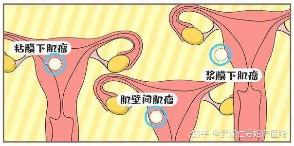 武漢仁愛婦產醫院每4個女人中就有1個患子宮肌瘤