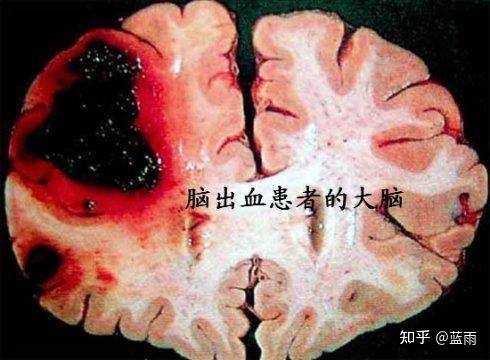 脑梗死静脉溶栓的适应症及禁忌症 - 知乎