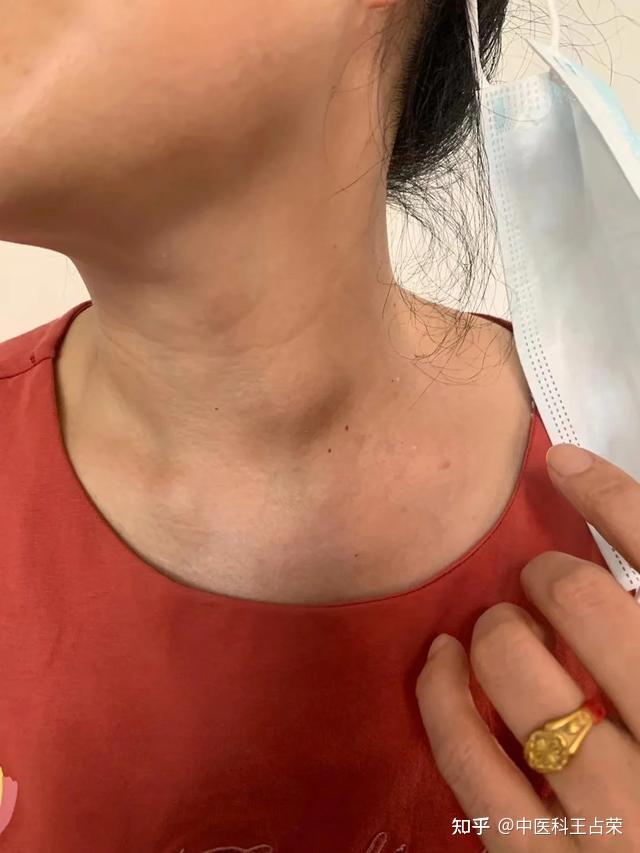 寒湿体质导致甲状腺囊肿散寒除湿活血全方位解决结节问题
