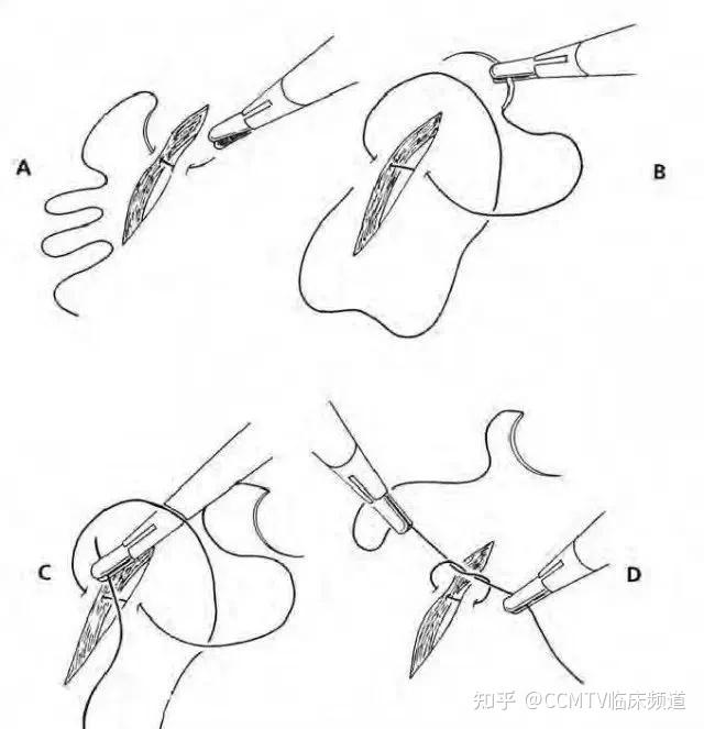 外科缝合打结方法图片