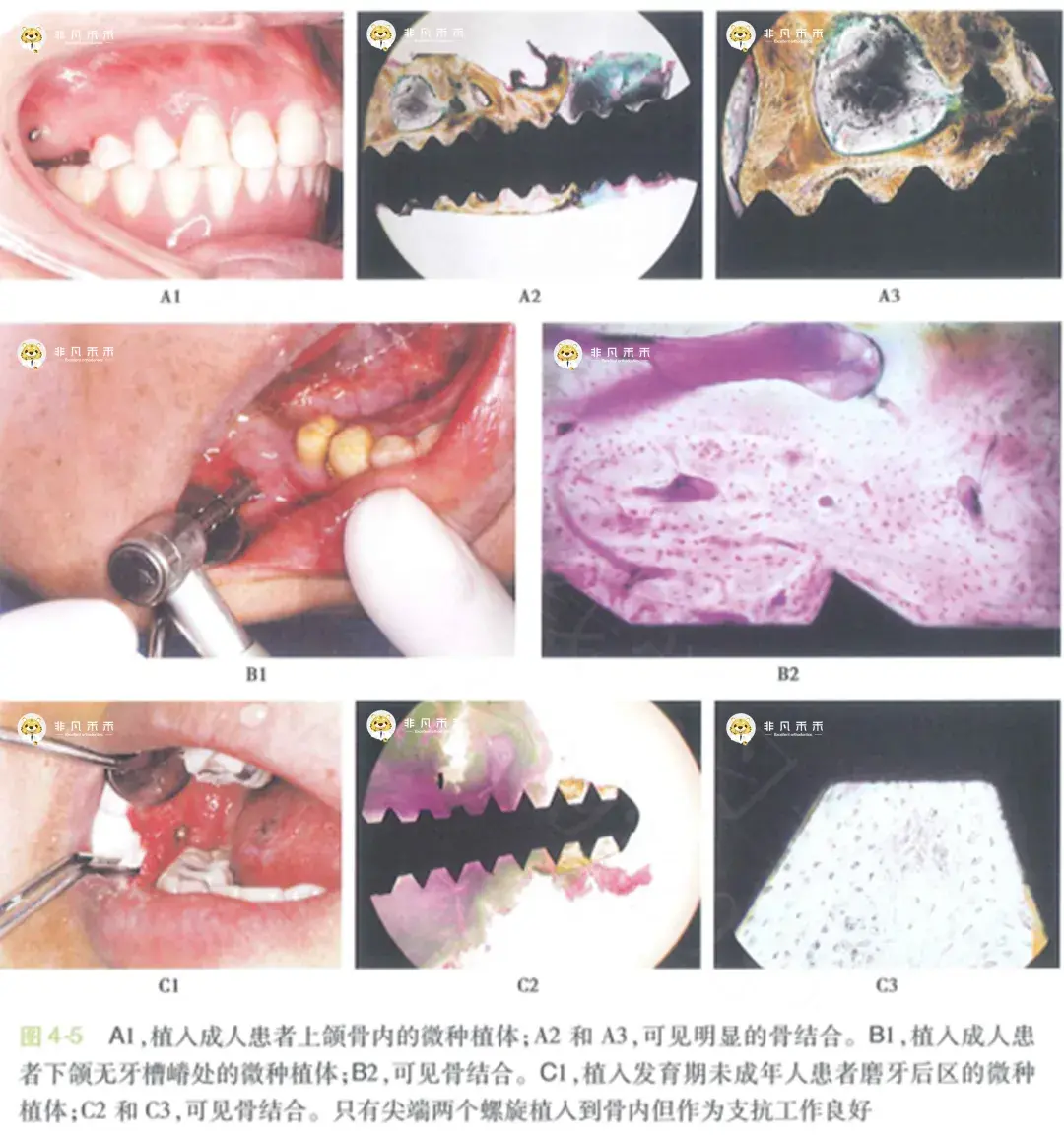 正畸科普支抗钉可以形成骨结合吗