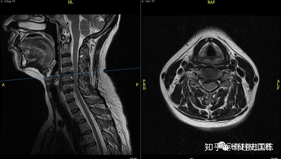 颈椎x线检查,椎体后缘骨赘形成,颈椎mri显示c3/4,c4/5,c5/6椎间盘突出