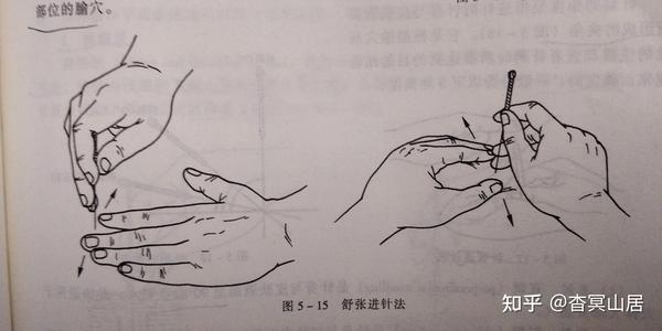 笔记摘要——针灸技术:毫针刺法、补泻原则与灸法概要 - 知乎