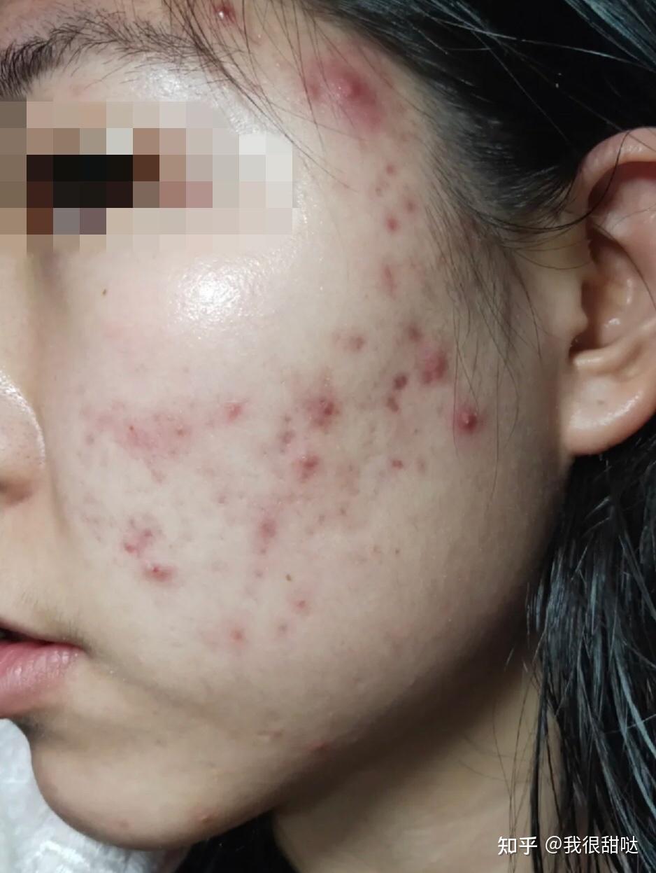 教你如何高效精准祛除红褐黑痘印!20天亲测打卡!痘印全部消失了 - 知乎