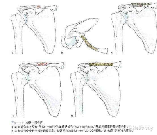 锁骨骨折解剖图片