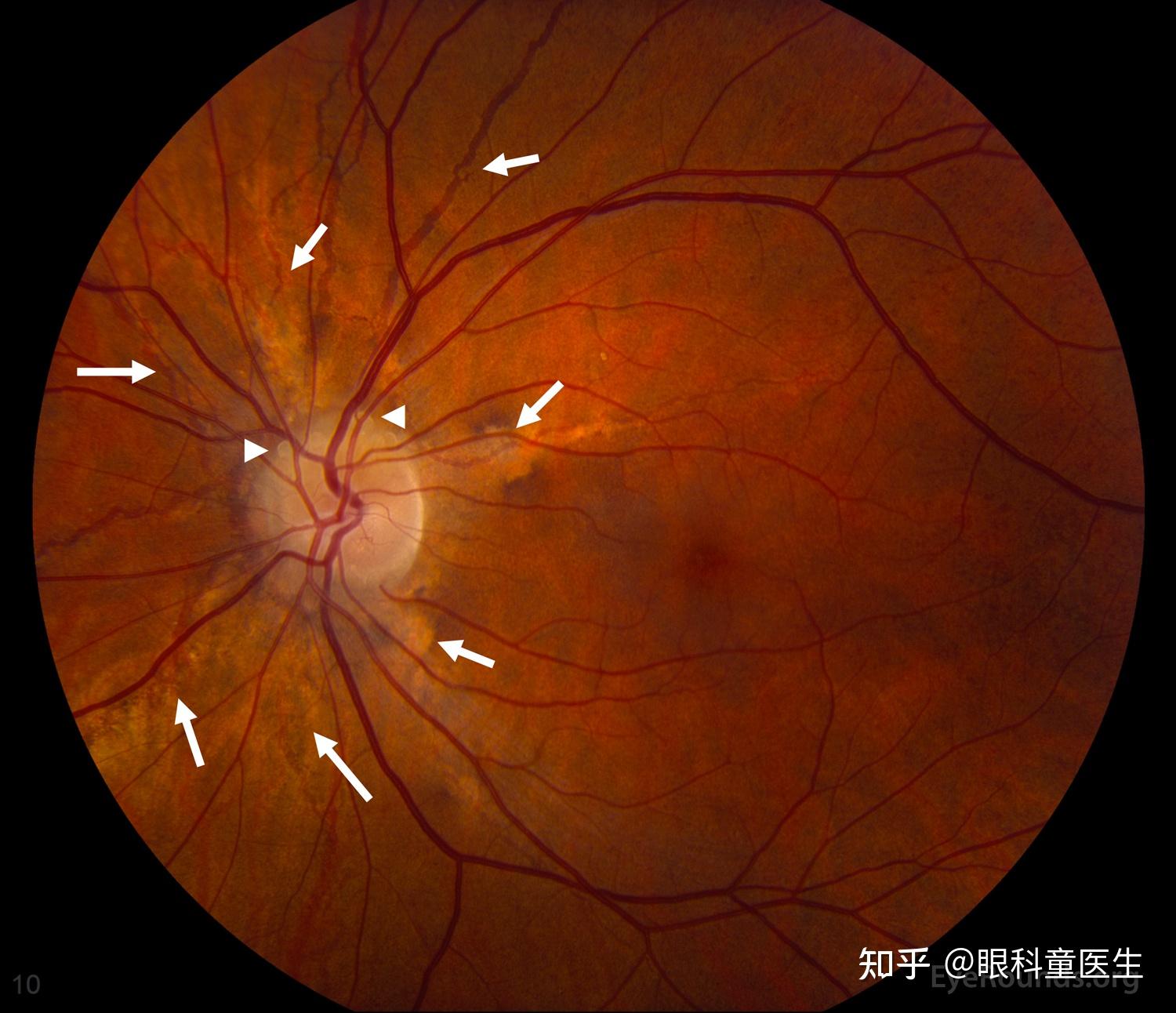 血管壁玻璃样变性图片